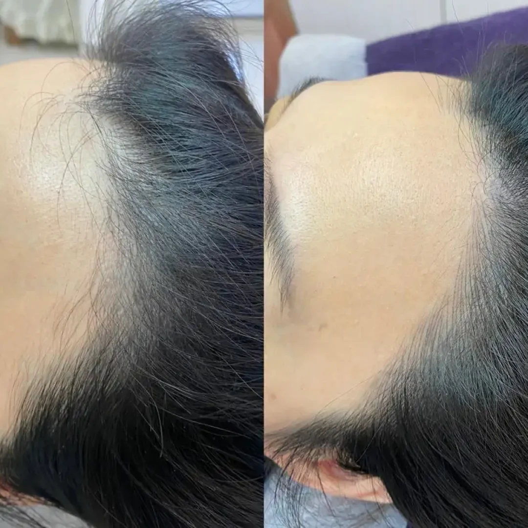 舞妝美睫紋繡美學-台北東區霧眉-台北美睫美瞳線-台北東區霧唇推薦_240930_projects_髮際線_04